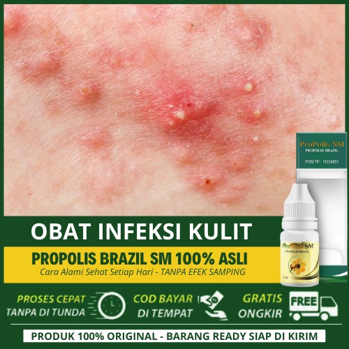 Obat Infeksi Kulit Karena Bakteri Jamur Pada Anak Di Wajah&Kepala - Kulit Gatal Bernanah | Propolis