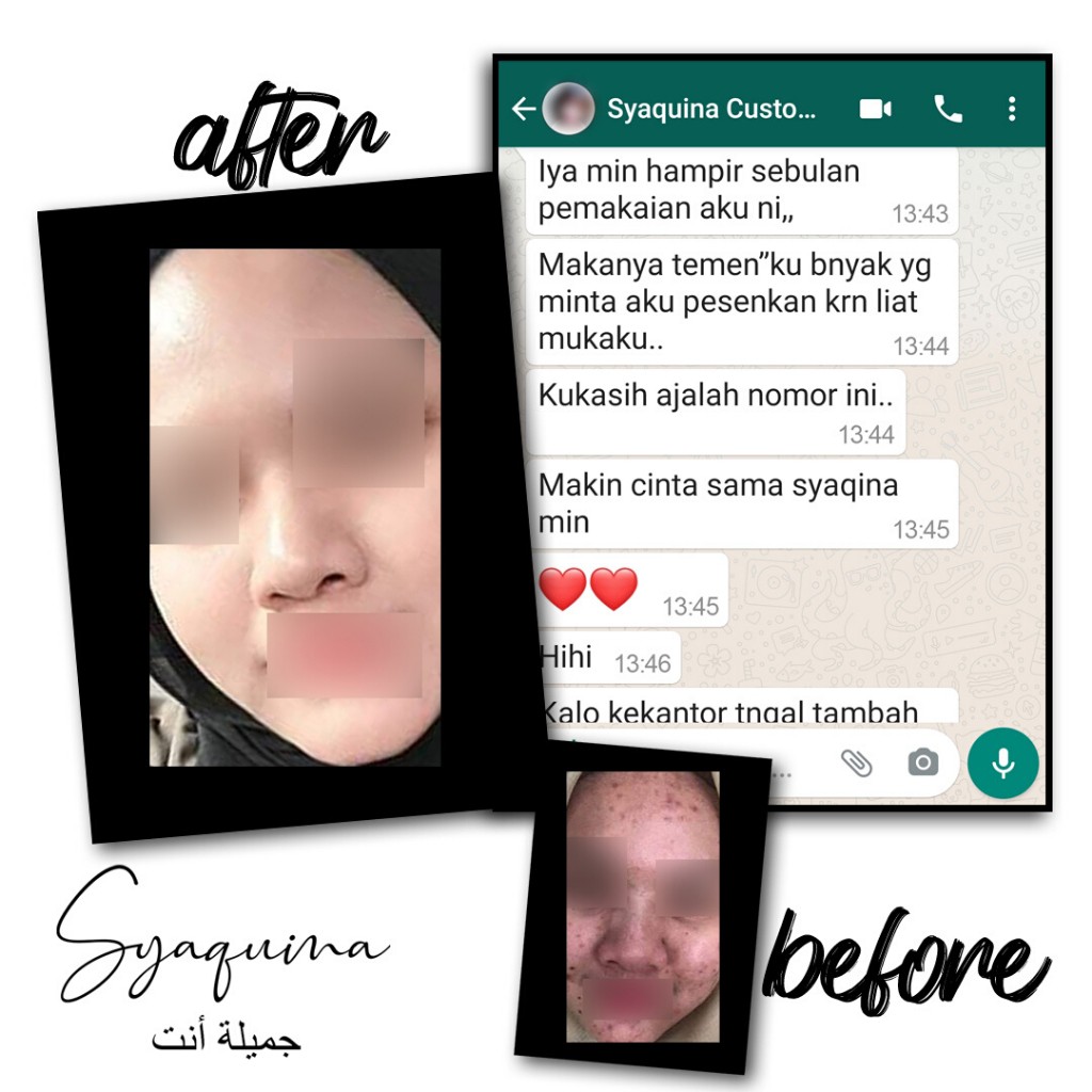 Syaquina Premium Paket Acne Series / Skincare Kulit Jerawat & Berminyak / Formulasi Dokter BPOM MUI-3