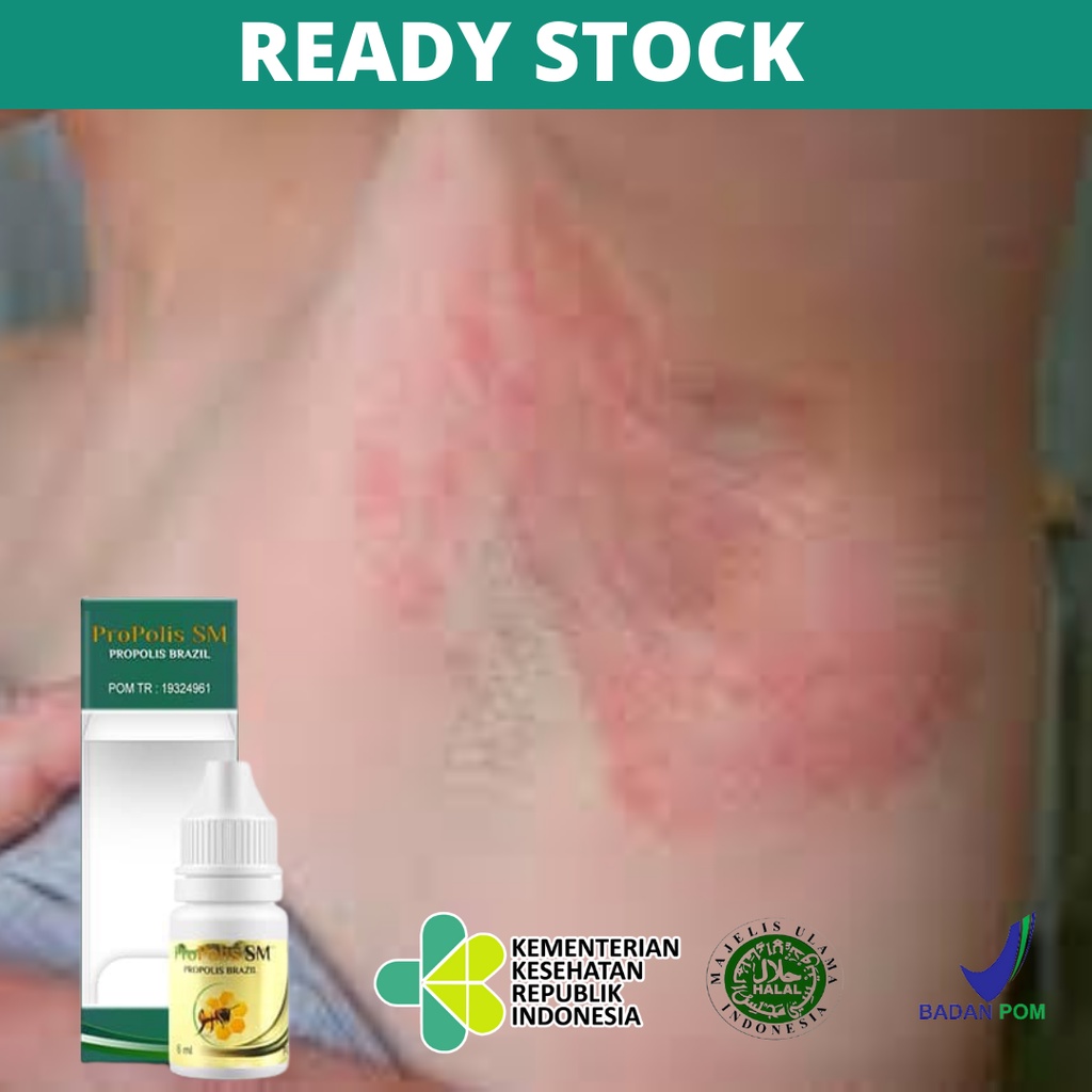 Obat Untuk Iritasi Ketiak, Gatal Merah Pada Ketiak, Infeksi Jamur Ketiak Dermatitis, Dermatitis Atop