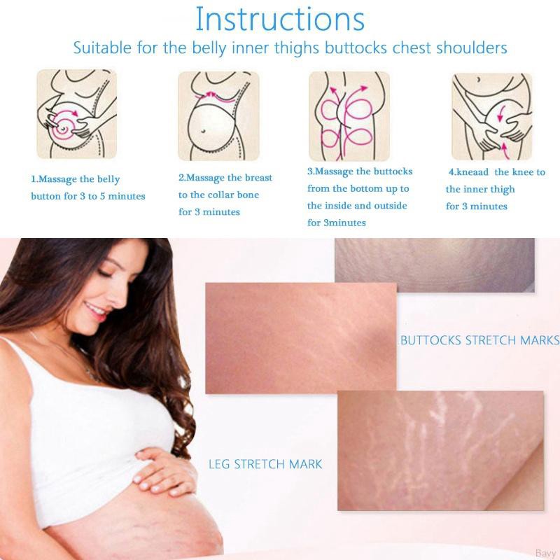 Krim Mark Untuk Menghilangkan Stretch Mark Stretch Mark Shopee Indonesia