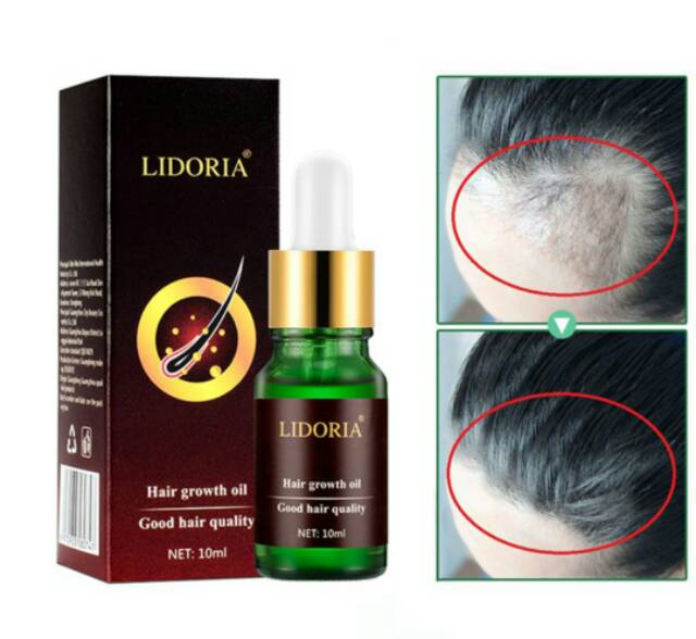 Herbal penyubur rambut atasi kebotakan