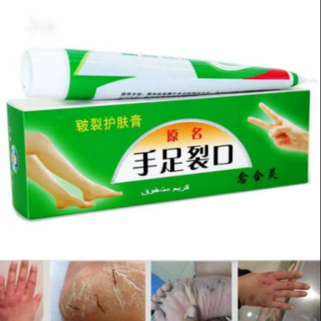 Salep China Untuk Kulit Mengelupas Murah Shopee Indonesia