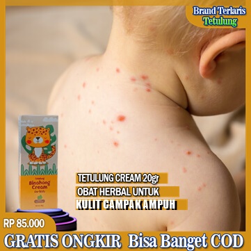 Obat Campak Anak Salep Campak Anak Paling Ampuh Menghilanglkan Campak Bayi  Cream Binahong For Kids 