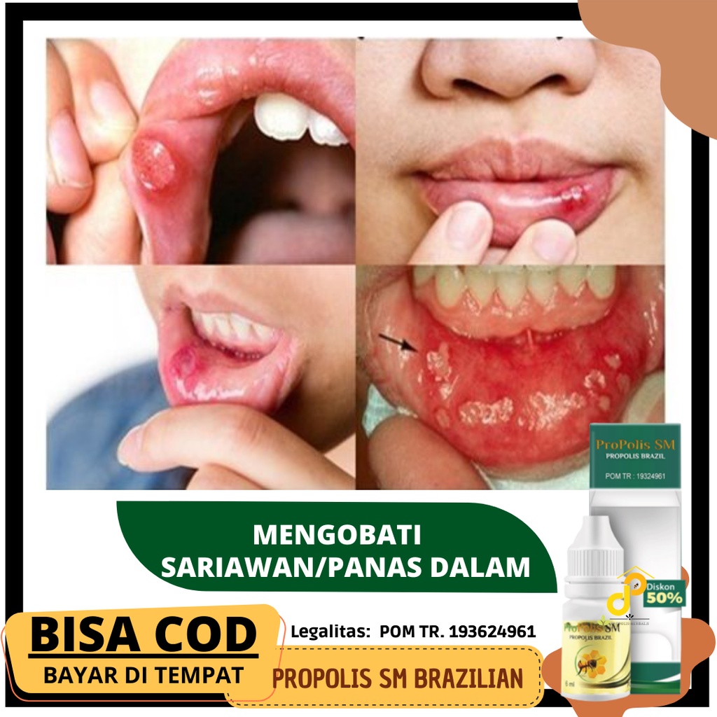 Propolis SM, Obat Sariawan di bibir, Obat Sariawan anak dan dewasa,Obat Herbal Sariawan