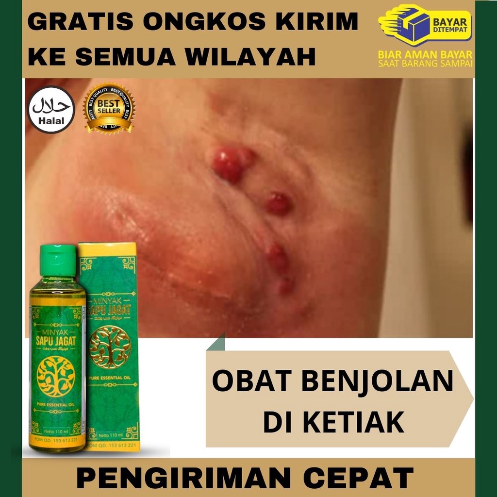 Jual Obat Benjolan Di Ketiak Obat Benjolan Sekelan Di Ketiak Ketiak Bengkak Dan Sakit 2053