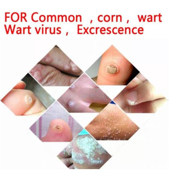 Wart Removal Cream Repair And Clean Skin Tag Remover 20g - Menghilangkan Kutil Tahi Lalat Mata Ikan Sumifun Obat Kutil