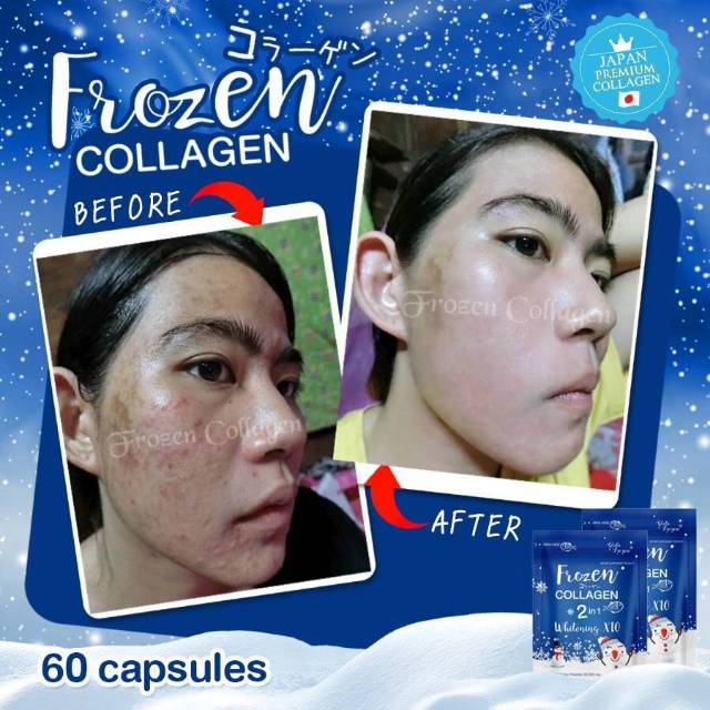 FROZEN COLLAGEN
