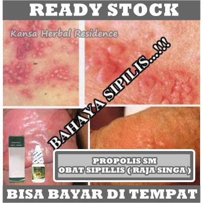 Obat Sipilis Kencing Nanah, Obat Gonore, Obat Herbal Sifilis, Obat Penyakit Kelamin, Penis Bernanah / Keluar Cairan Kental Putih . Obat Herbal Gonore, Trikomosis, Obat Raja Singa, Obat Herbal Kencing Bernanah, Kencing Perih &amp; Panas 100% Propolis SM