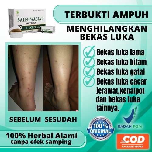 KRIM PENGHILANG BEKAS LUKA KORENG KORENGAN DIKAKI HITAM ANAK BAKAR DI WAJAH GATAL GORESAN BPOM AMPUH