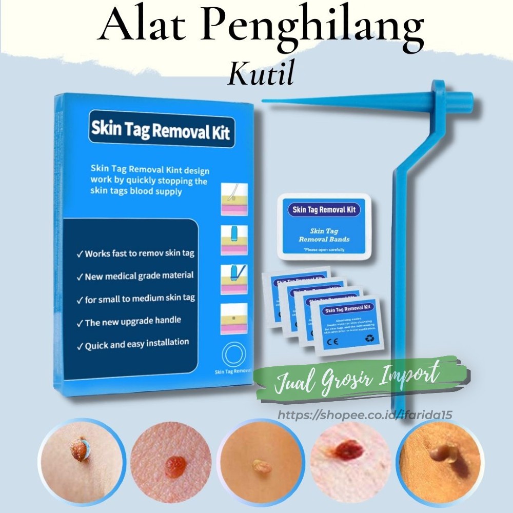 Obat Alat Penghilang Kutil Wart Remover Kit Penghilang Kutil Tahi Lalat Original Ampuh Permanen Garansi Uang Kembali