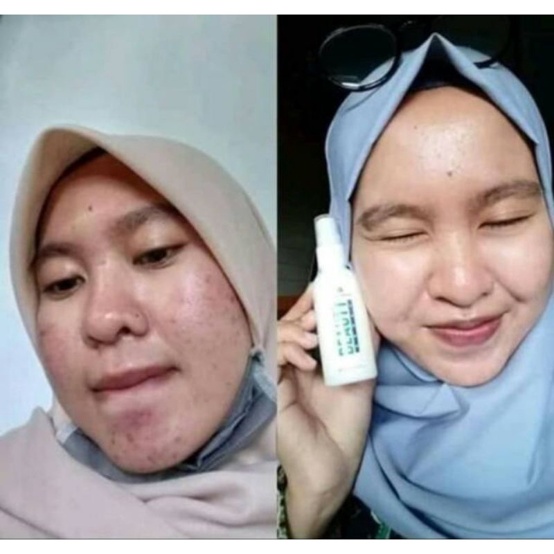 NATURA BEAUTY SPRAY ORIGINAL / SERUM OBAT JERAWAT BATU PRIA WANITA / PENGHILANG JERAWAT