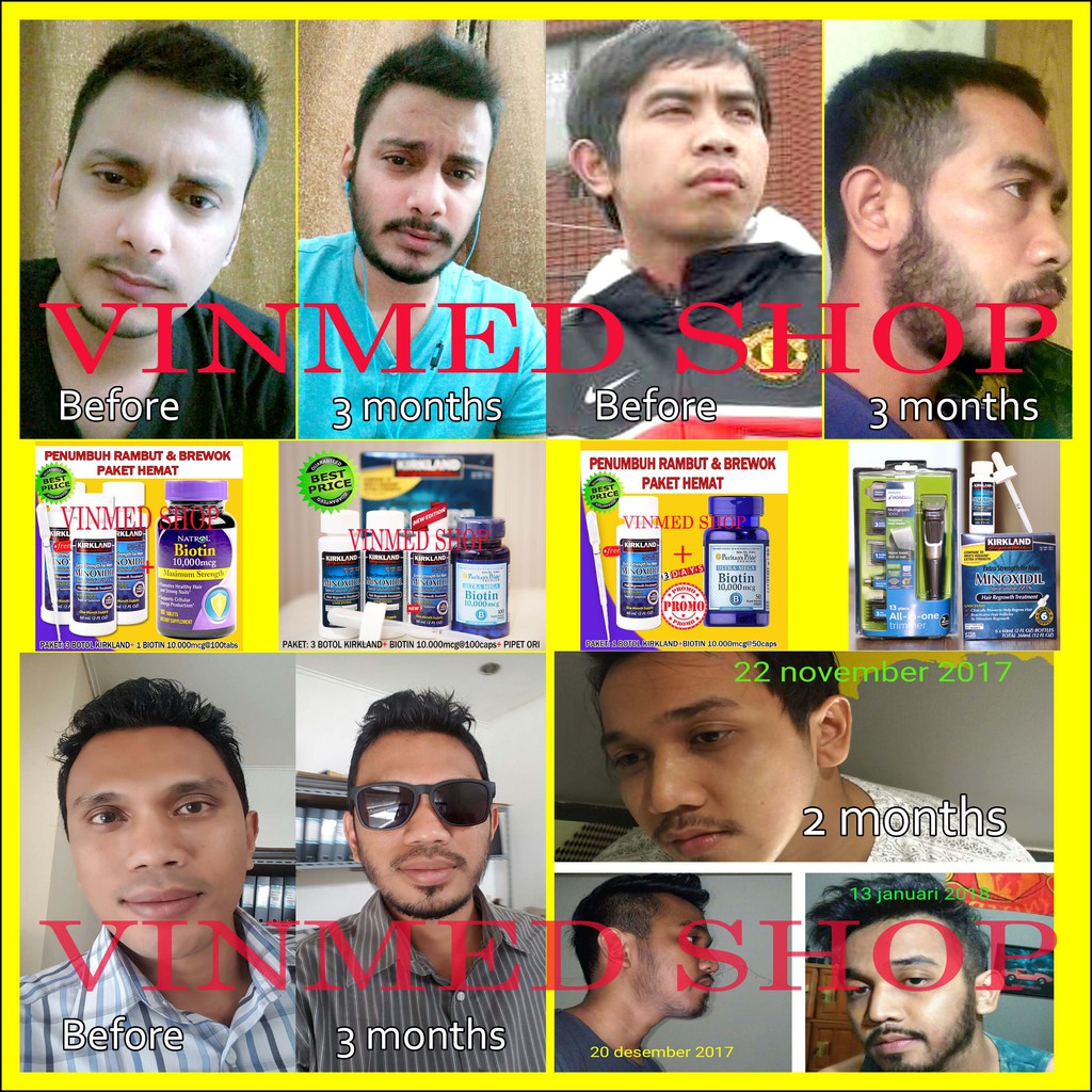 Kirkland Minoxidil 5% + Biotin 10.000mcg Bonus Pipet Ori PAKET KOMPLIT