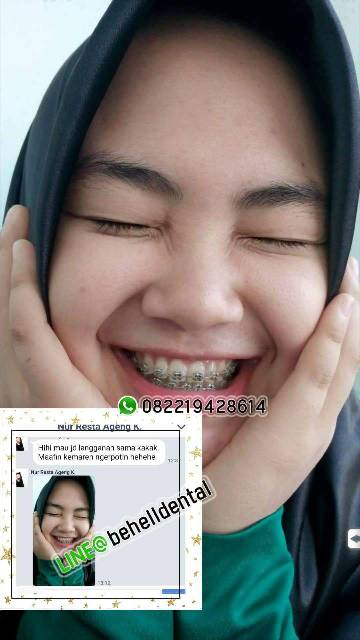 PAKET BEHEL PERMANEN METAL ORTHO BRACKET ORTHO CLASSIC USA ROTH WITH HOOK - Braces Dental OC OrthoClassic Untuk Perbaikan / Perawatan Gigi - Kawat Orthodontic Metalic - Behelldental Mim