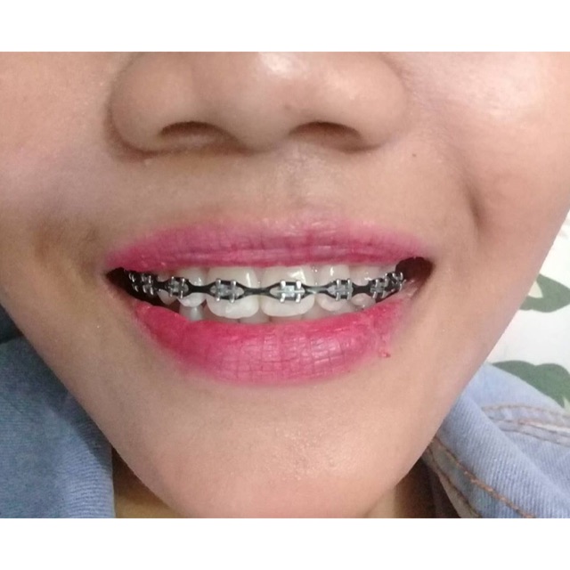 Warna Karet Behel Yang Cantik Di Gigi Warna Karet Behel Yang Cantik Di Gigi