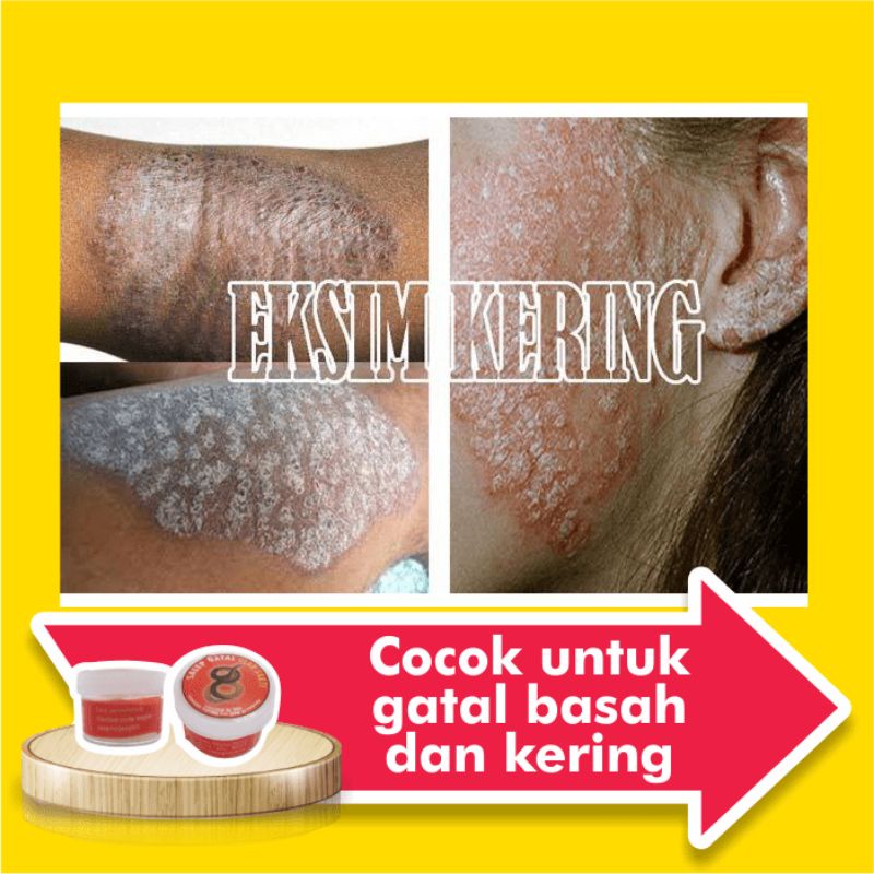 Obat Salep Gatal Eksim Kering Menahun Paling Ampuh Kulit Gatel Basah Selangkangan Kurap Kutu Air Luka Diabetes Panu Kudis Kadas-3