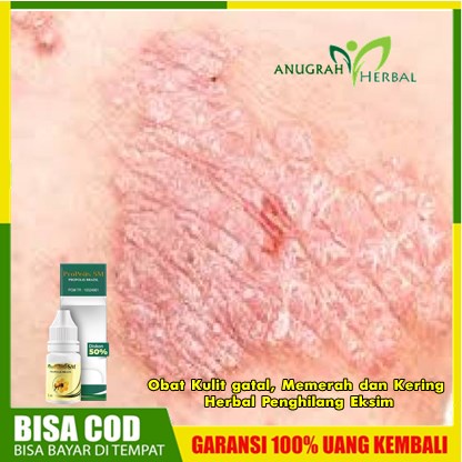 Obat Kulit gatal, Memerah dan Kering  Herbal Penghilang Eksim (dermatitis atopik), Infeksi kulit jam