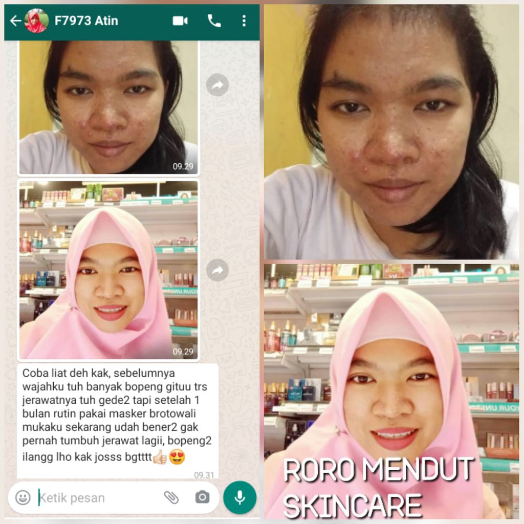 Masker Brotowali Penghilang Jerawat Bekas Jerawat Pencabut Komedo Roro Mendut Mini Acne Jerawat 20gr