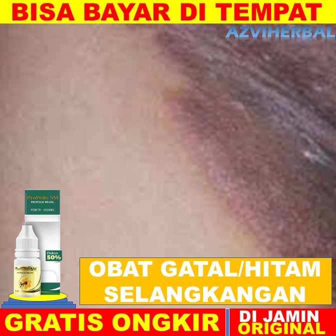 Obat kurap selangkangan, krim selangkangan hitam, obat gatel selangkangan, salep selangkangan gatal 