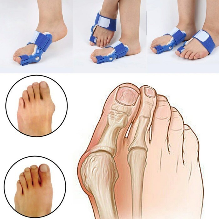 FMFIT Janet (Beli 1 Dapat 2) Alat Terapi Koreksi Bunion Jempol Kaki