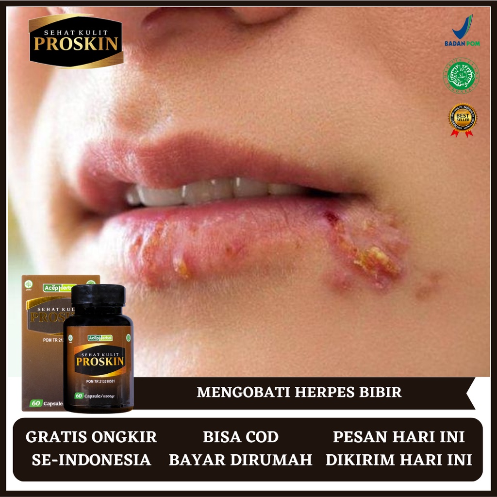 Obat Herpes, Obat Herpes Bibir, Obat Bintik Merah Pada Bibir, Obat Herpes Genital, Obat Herpes Zoste