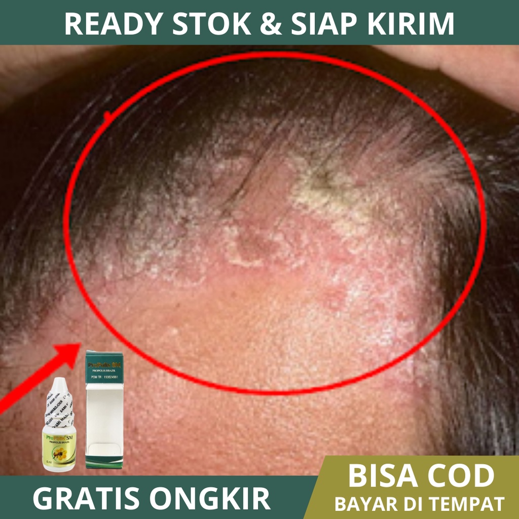 Obat Ketombe Berkerak di Kepala, Obat Borok Di Kulit Kepala, Obat Ketombe Parah Berkerak, Obat Kepal