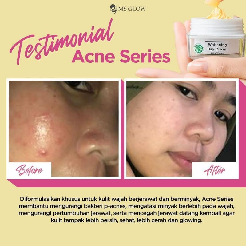 Ms Glow Paket Acne Free Pouch