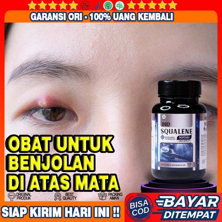 Obat Benjolan di Atas Mata - Obat Benjolan di Alis - Obat Benjolan di Jidat Kebentur - Obat Benjolan