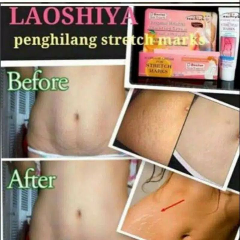 CREAM PENGHILANG STRETCH MARK SELULIT GURATAN KULIT di Perut Kaki Tangan | Laoshiya Cream BPOM