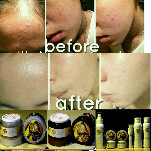 Paket Jerawat oily skin /sensitive skin V Beauty Care - Victory beauty care