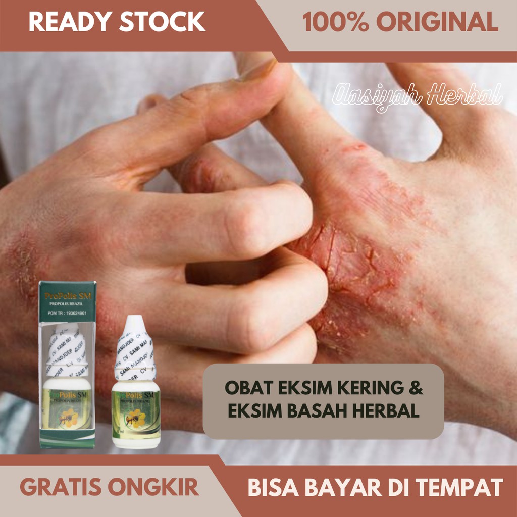 Obat Eksim Kering Menahun, Obat Eksim Basah, Obat Exim, Obat Gatal Eksim Herbal Propolis SM Original
