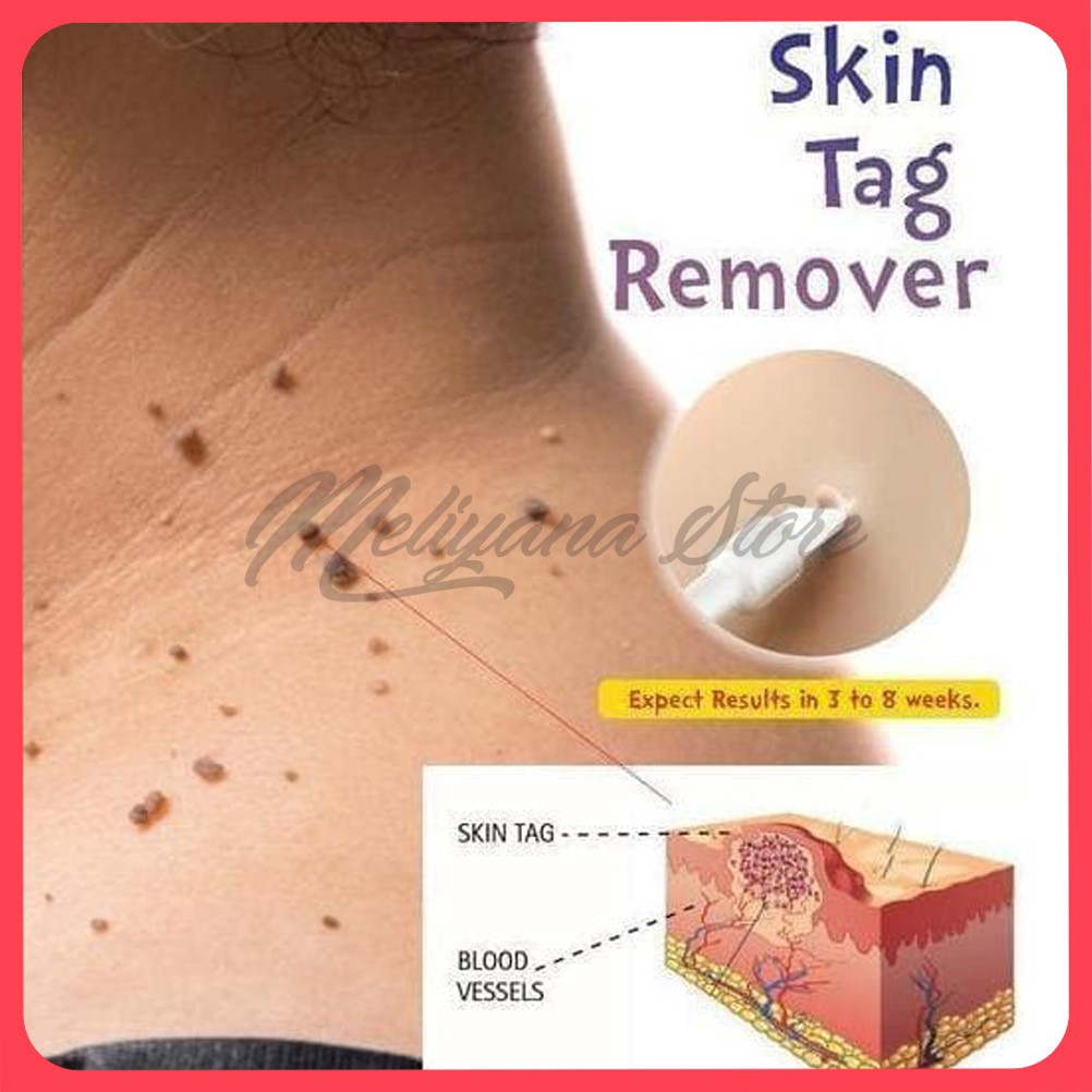 SKINTAG REMOVER Cairan Cream Penghilang Kutil Tahi Lalat Mata Ikan Kapalan