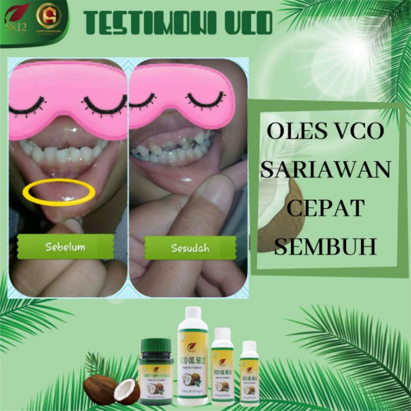 Vco Oil SR12 Obat Sariawan / Obat Sakit gigi / Radang tenggorokan / Panas Dalam / Flu dan Batuk