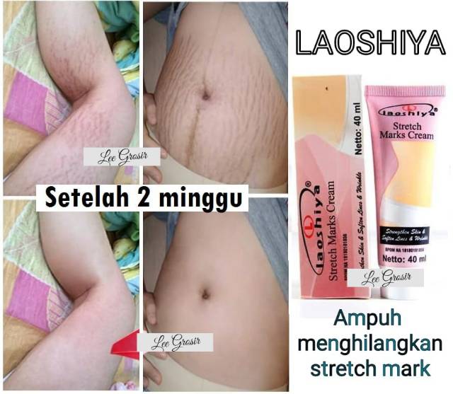 penghilang strechmark salep penghilang bekas luka penghilang keloid penghilang selulit ampuh losiya