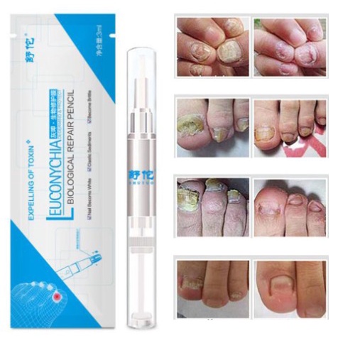 Obat Kuku Jamur dan Kuku Yang Rusak Ampuh - Obat Jamur Kuku Kaki Ampuh Jamur Kuku Jamur Kuku Obat - 