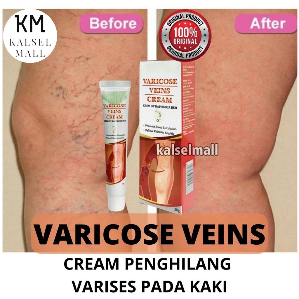 Obat Salep Krim Cream Varises Parises Farises Kanyehb ORIGINAL 100% Kaki Betis Kemaluan Testis Tangan Urat Membengkak Varicose Veins Paling Ampuh Ramuan Cina Herbal Tradisional OC11