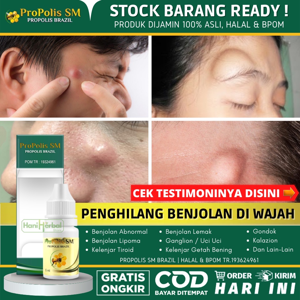 Obat Oles Untuk Benjolan di Wajah 100% Asli Alami - Hilangkan Benjolan Dengan Aman, Salep Penghilang