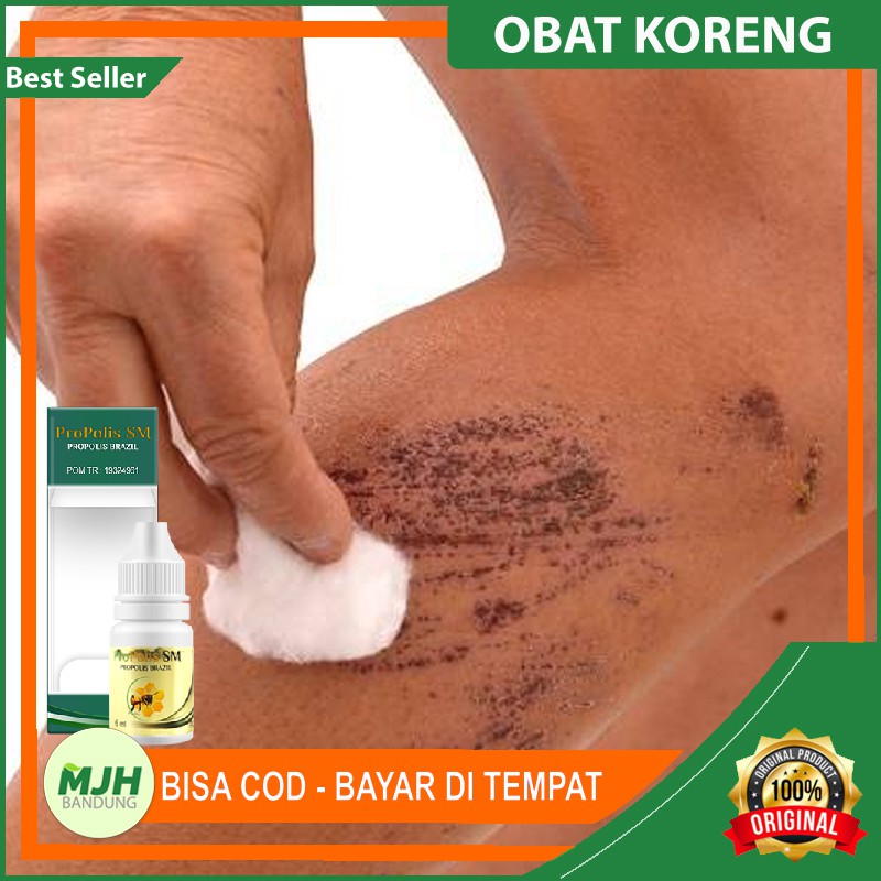 Obat Koreng / Korengan di Kaki dan Selangkangan - Koreng Borok Menahun - Korengan Gatal