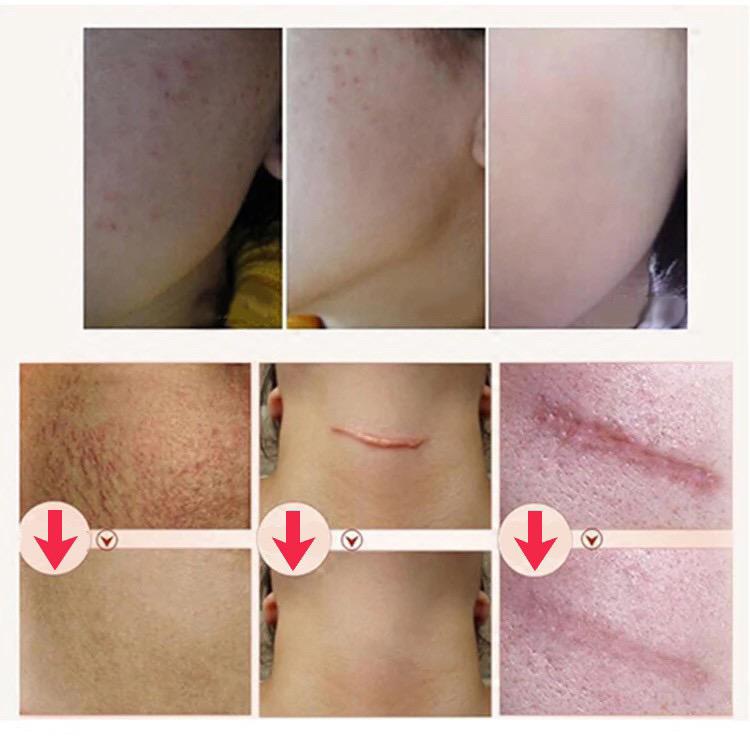 Dermatik Ultra Gel/ Dermatic /Menghilangkan Stretchmark / Bekas Luka Keloid 15gr