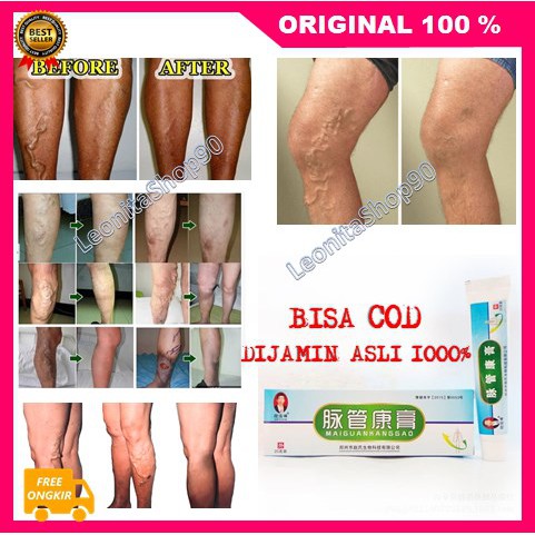 [BISA COD] Obat Varises Maiguankanggao Ampuh Original