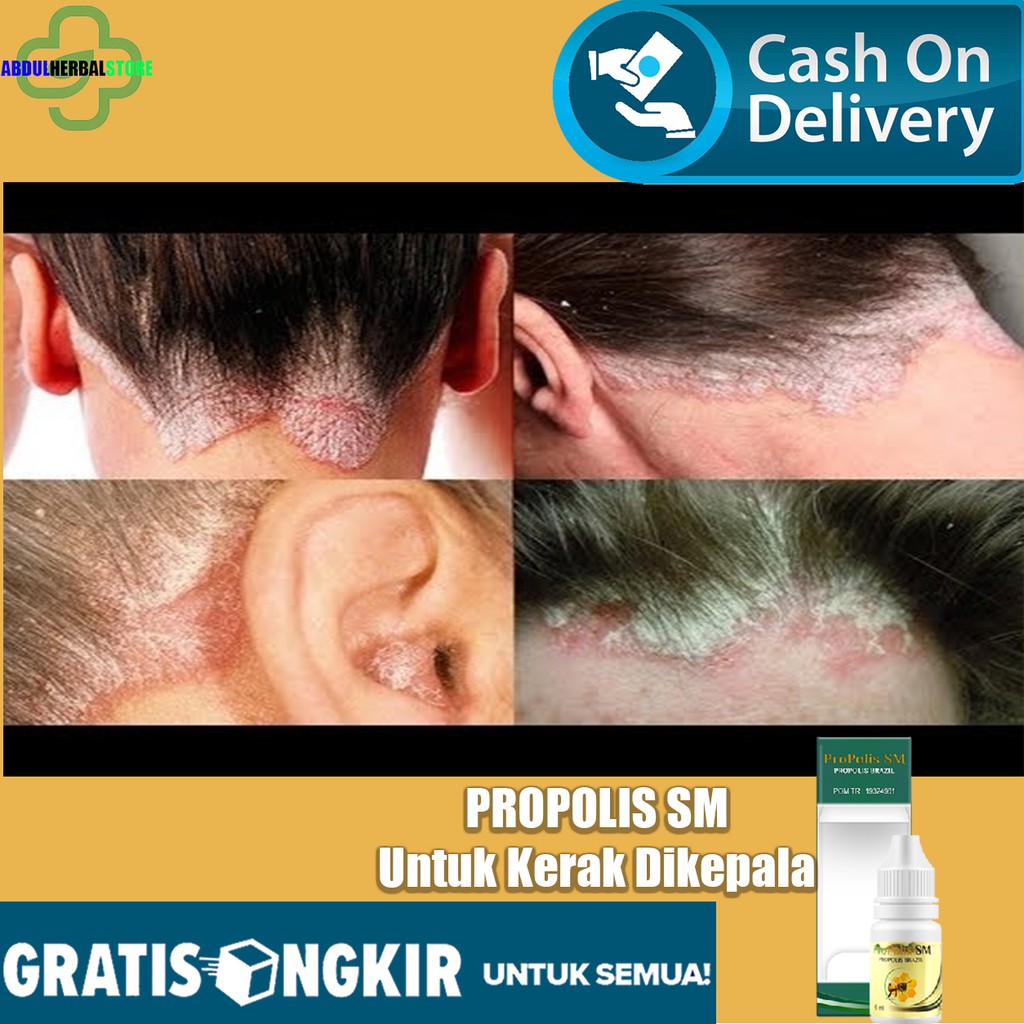 Jual Obat Ketombe Berkerak, Koreng di Kulit Rambut Kepala, Obat Kulit