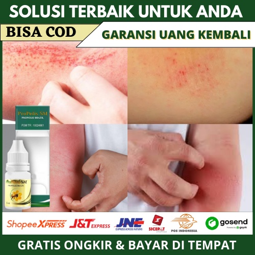 Obat Gatal Dilipatan Siku Dan Lutut, Kulit Merah Panas, Salep Kulit Bersisik, Kulit Gatal-Gatal, Inf