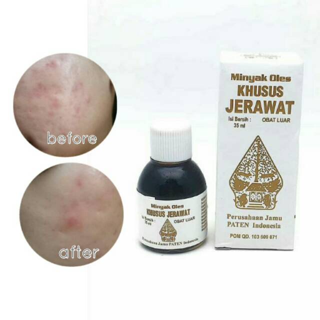 Minyak Oles Khusus Jerawat Minyak Oles Cap Wayang Penghilang Jerawat Perawatan Wajah Original Minyak Oles Khusus Jerawat Cap Wayang 35ml BPOM