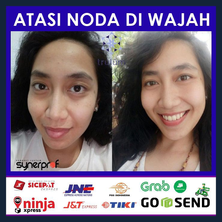 Skincare Herbal Alami Ampuh Obati Bekas Jerawat Flek HItam & Keriput