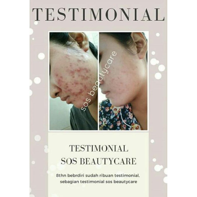 sabun jerawat soap bar acne