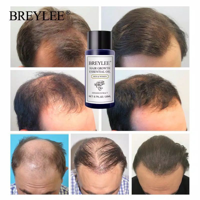 Breylee Serum Penumbuh Rambut | Hair Growth Essential Oil - Mencegah kerontokan Rambut (20ml)