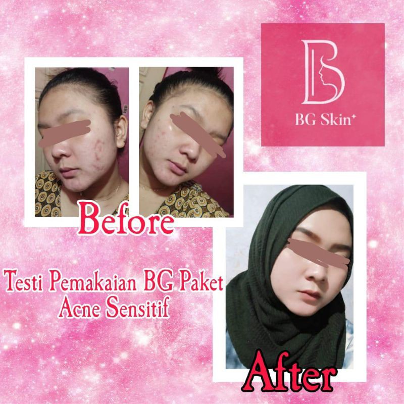 PAKET ACNE SENSITIF/ LUXURY/ BRIGTHENING BEAUTY GLOW SKINCARE ORIGINAL 100% BG SKINCARE-5