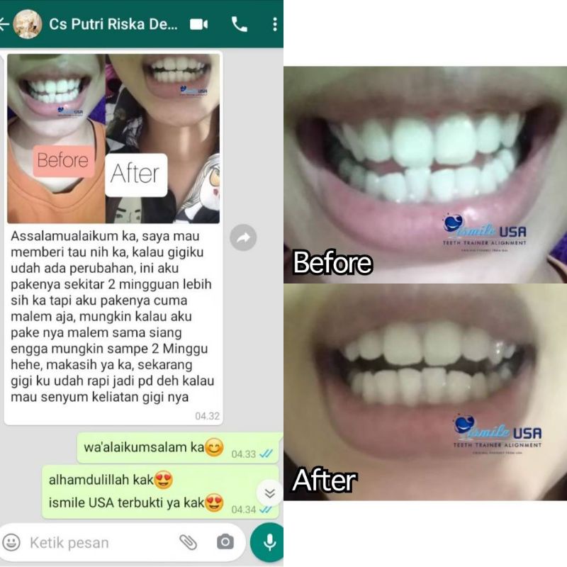 Garansi 100% Original IsmileUSA/ Ismile USA/Perapi gigi/Teeth 