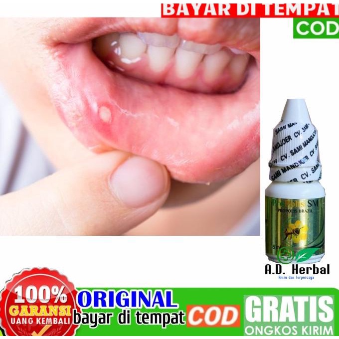 Obat sariawan tetes herbal propolis, sariawan akut kronis menahun