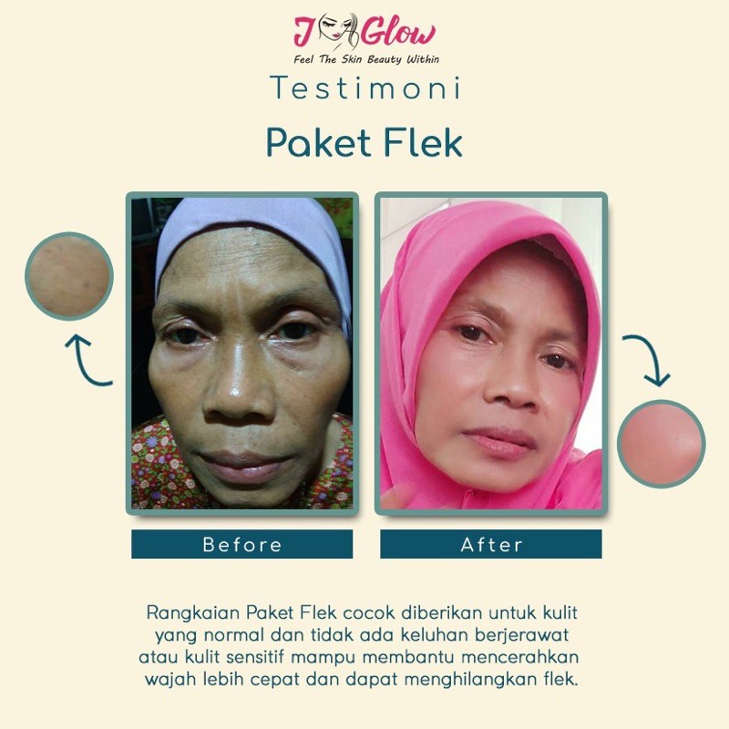 J GLOW SKINCARE FLEK WHITENING/ JGLOW PAKET FLEK HITAM