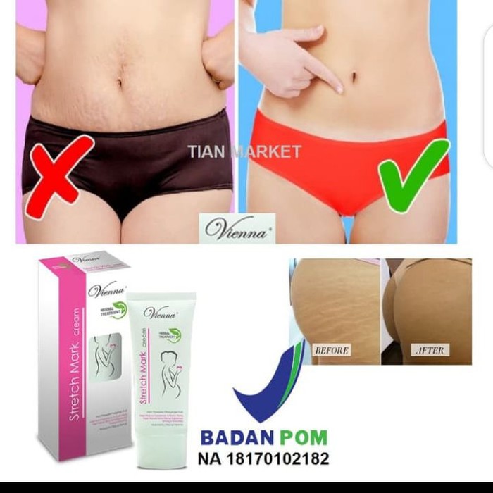 VIENNA STRETCHMARK CREAM - CREAM PENGHILANG STRETCHMARK PALING AMPUH